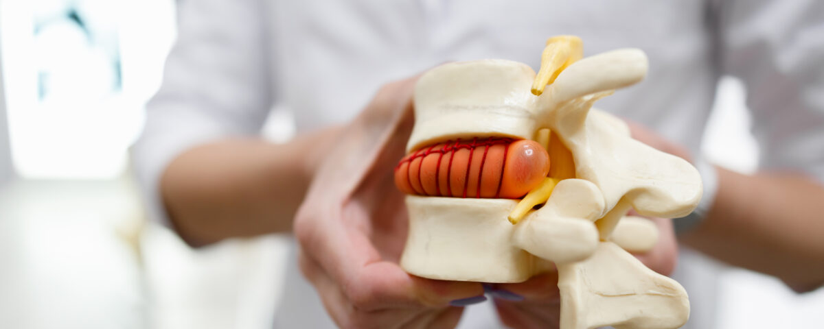 the doctor holds in his hands a model of a herniated lumbar disc of the spine e1700031877198