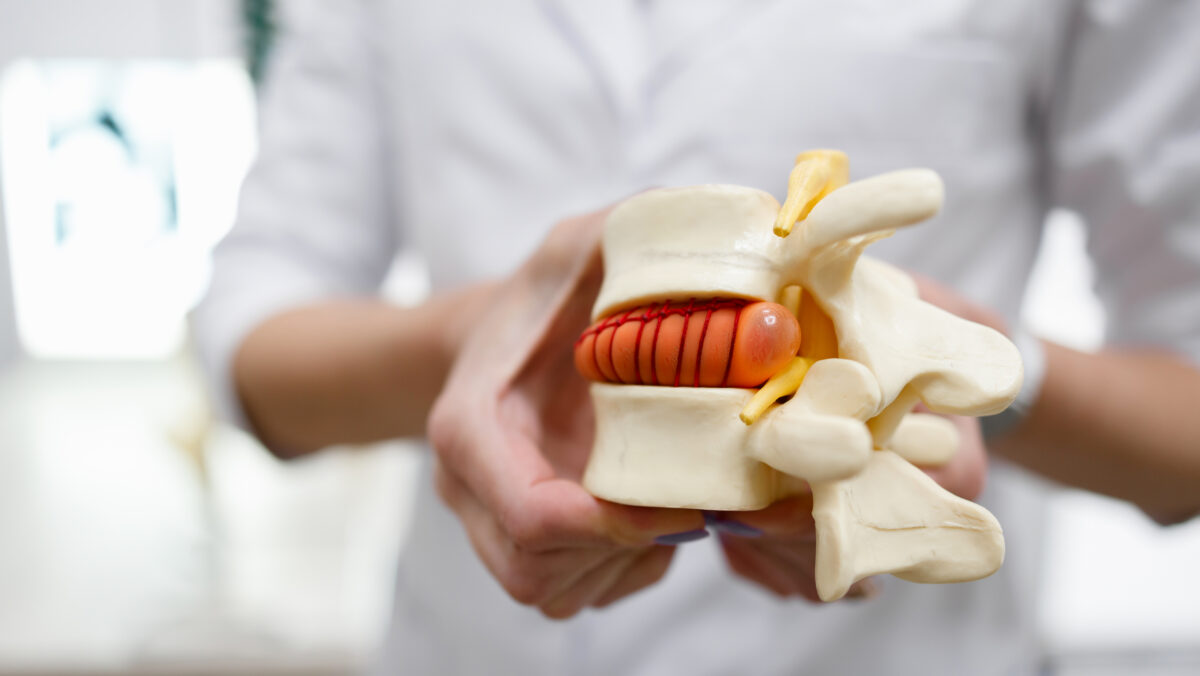 the doctor holds in his hands a model of a herniated lumbar disc of the spine e1700031877198