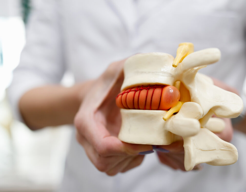 the doctor holds in his hands a model of a herniated lumbar disc of the spine e1700031877198