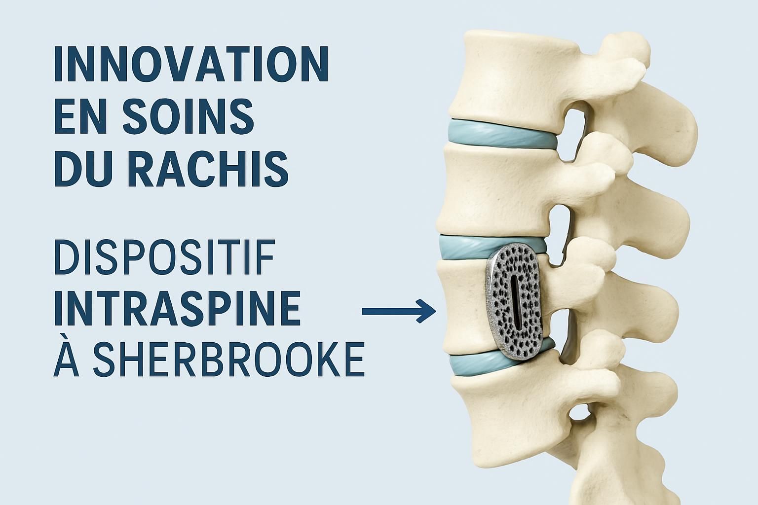IntraSPINE® à Sherbrooke : solution durable pour lombalgie chronique 7 découvrez intraspine® à sherbrooke, une solution durable et efficace pour soulager la lombalgie chronique et améliorer votre qualité de vie.